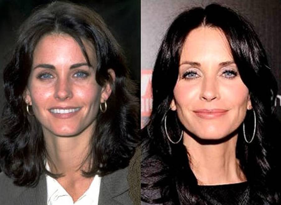 Courtney Cox’s Plastic Surgery